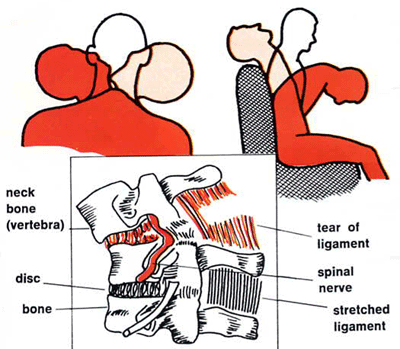 IMPACTO CERVICALGIA